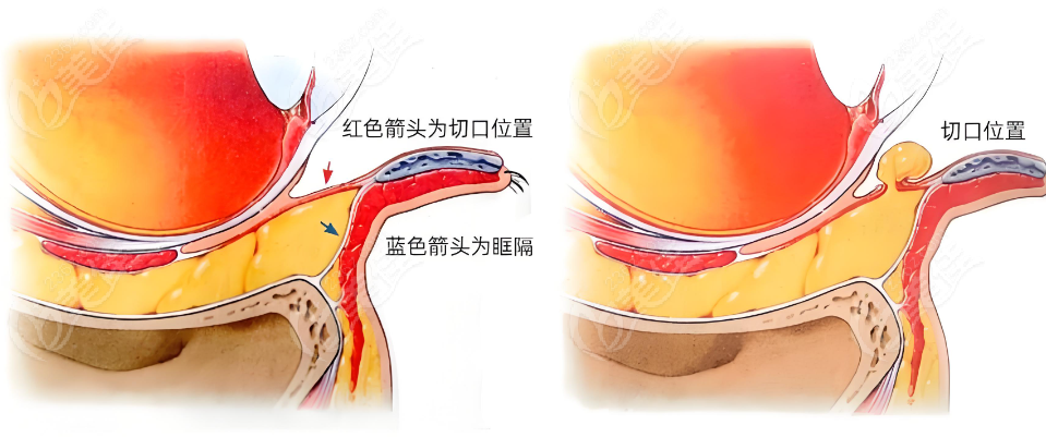 祛眼袋手術(shù)