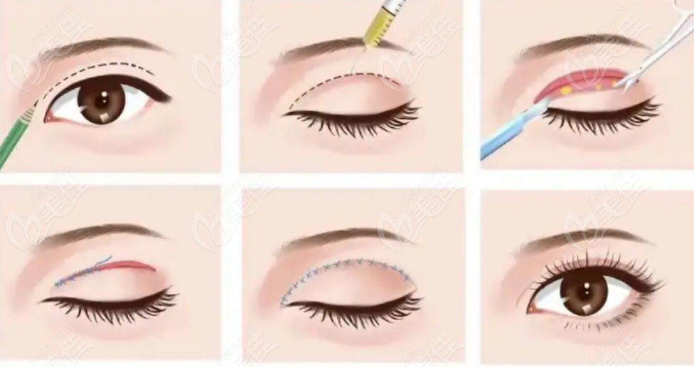 吕方中医生做双眼皮手术