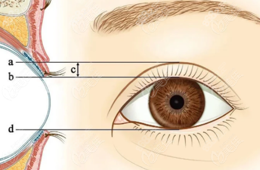 林晓燕医生割双眼皮实例