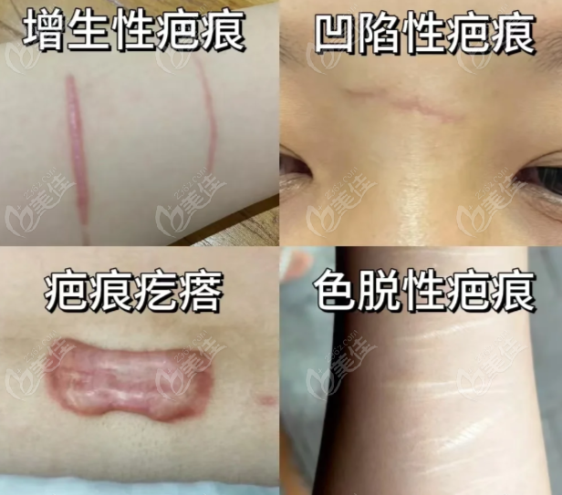 昆大疤痕医院疤痕切除精密缝合术收费标准