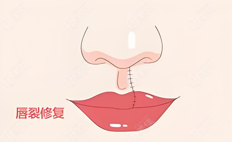 成都兔唇二次修復(fù)好的五家醫(yī)院:患者親評可修復(fù)的基本無痕跡,是唇裂患者的福音    m.236z.com
