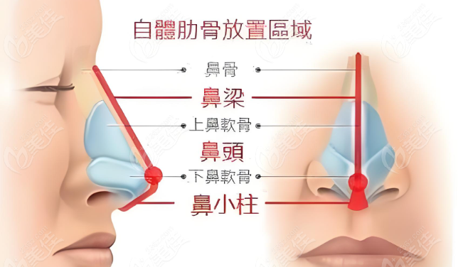 肋骨隆鼻