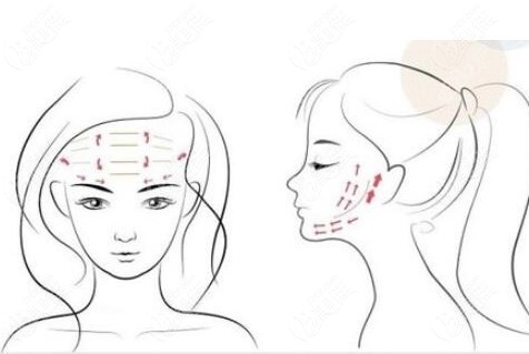 面部提升在线免费24小时问诊