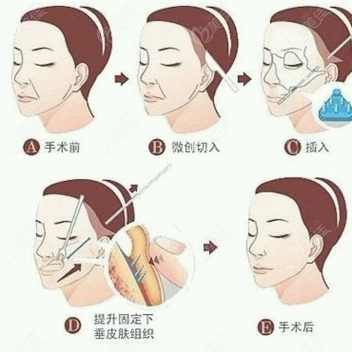 成都素美筋膜提升的口碑和评价好