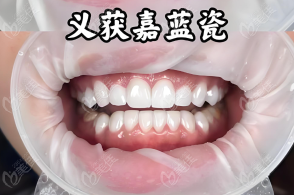 义获嘉蓝瓷牙贴面优点多