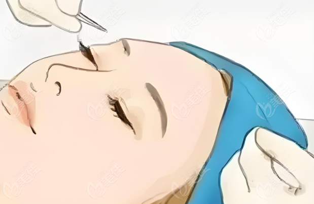 佀同帅医生眼整形修复技术好