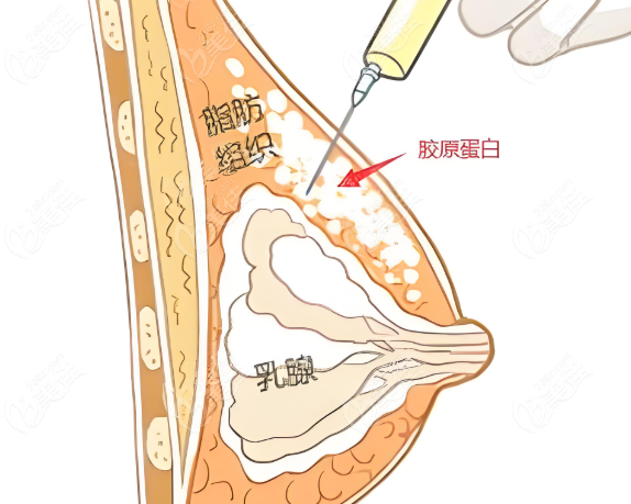 	蜜桃无痕丰胸多少钱?无痕蜜桃胶原丰胸的价格在4W-15W元起，能维持一年左右  美佳网