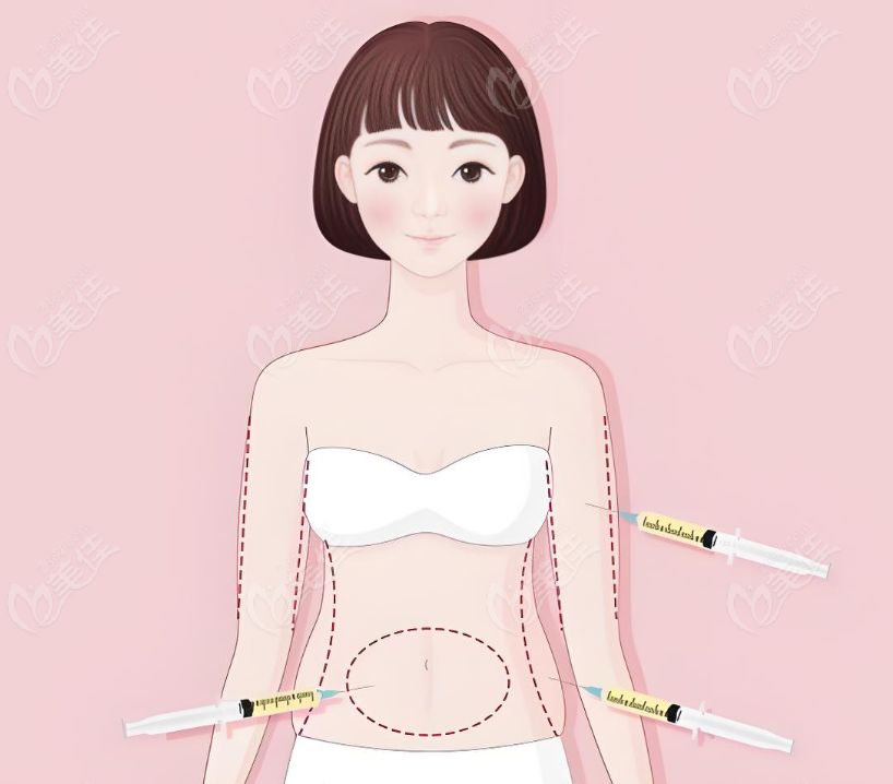 羅明生吸脂的口碑評(píng)價(jià) 羅明生吸脂的口碑評(píng)價(jià)