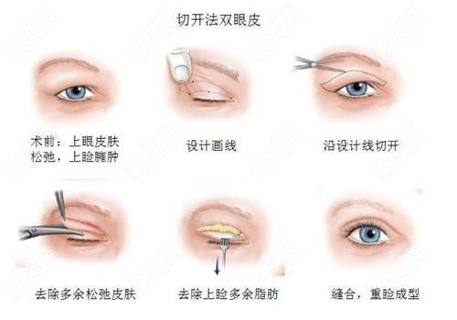 成都杨迪双眼皮修复贵吗