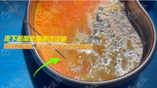 维密金雕治疗馒化脸好吗