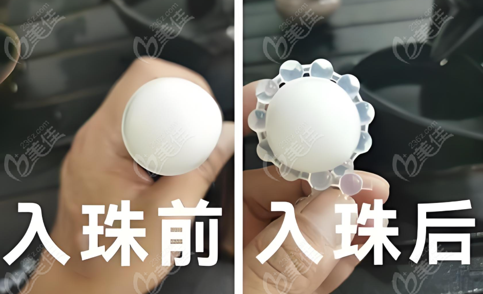 男士镶珠手术非骗局www.236z.com
