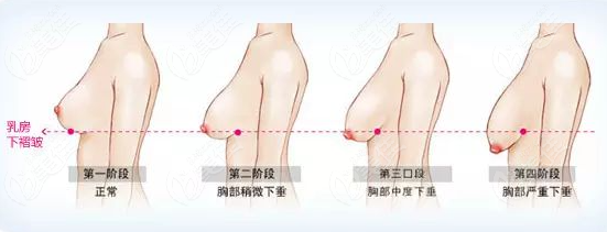 重慶乳房下垂矯正好的醫院排名：重慶華美做胸下垂矯正名實相符-穩占實力塑美！