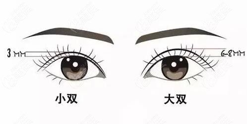 游鹏飞医生做双眼皮怎么样？听说他可以做不开刀双眼皮是真的吗？