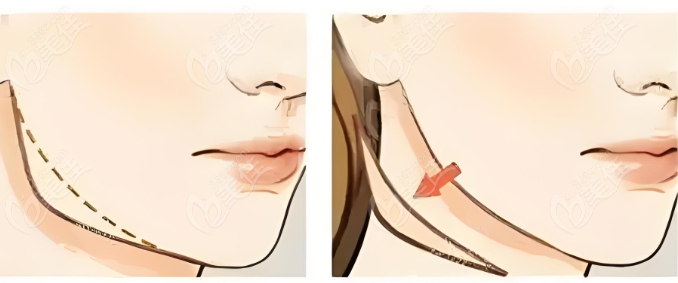 重慶磨骨手術(shù)價格收費一覽表m.pfflawyer.com