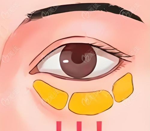 眼袋