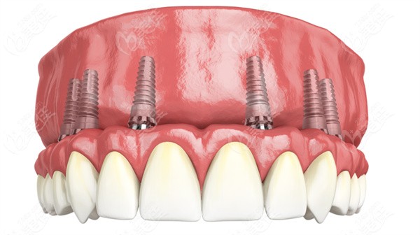 石家庄半口种植牙价格 石家庄半口种植牙价格