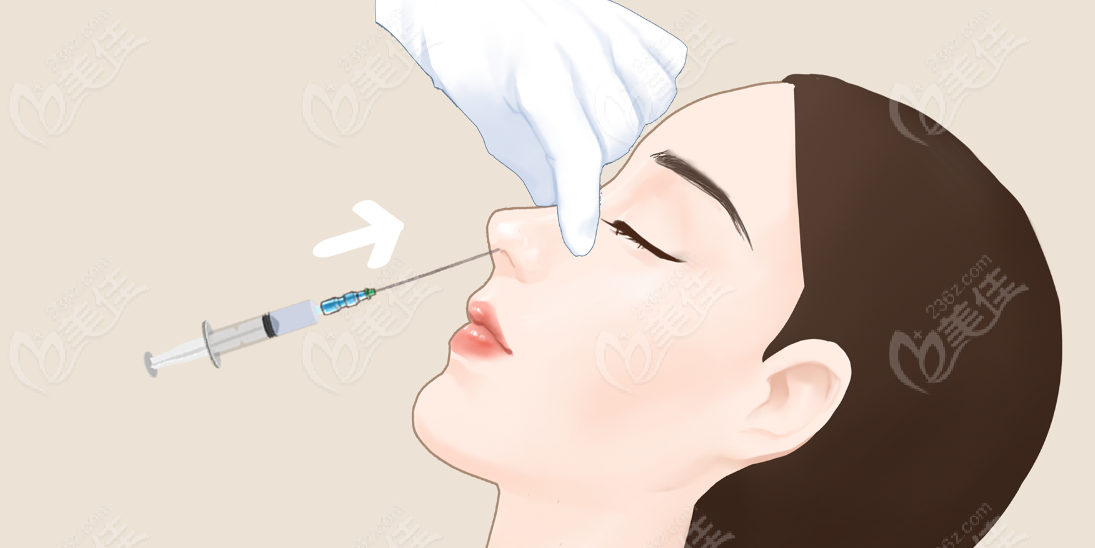 成都注射隆鼻哪里比較好?青羊區(qū)藝星|錦江區(qū)畫美|武侯區(qū)米蘭柏羽隆鼻出名且排名前三 