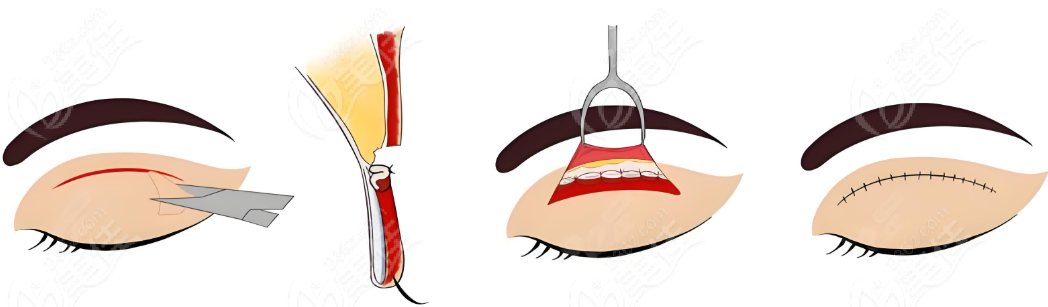呂方中做修復(fù)雙眼皮測評