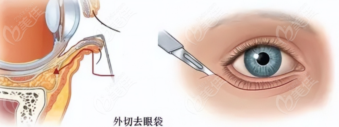 236z.com去眼袋手術(shù)示意圖