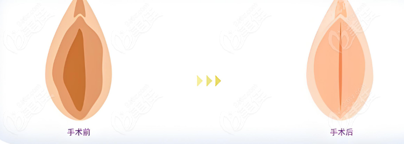 成都做紧缩手术哪家医院好?成都九龙医院私密科排名前三,技术口碑双在线！  美佳网