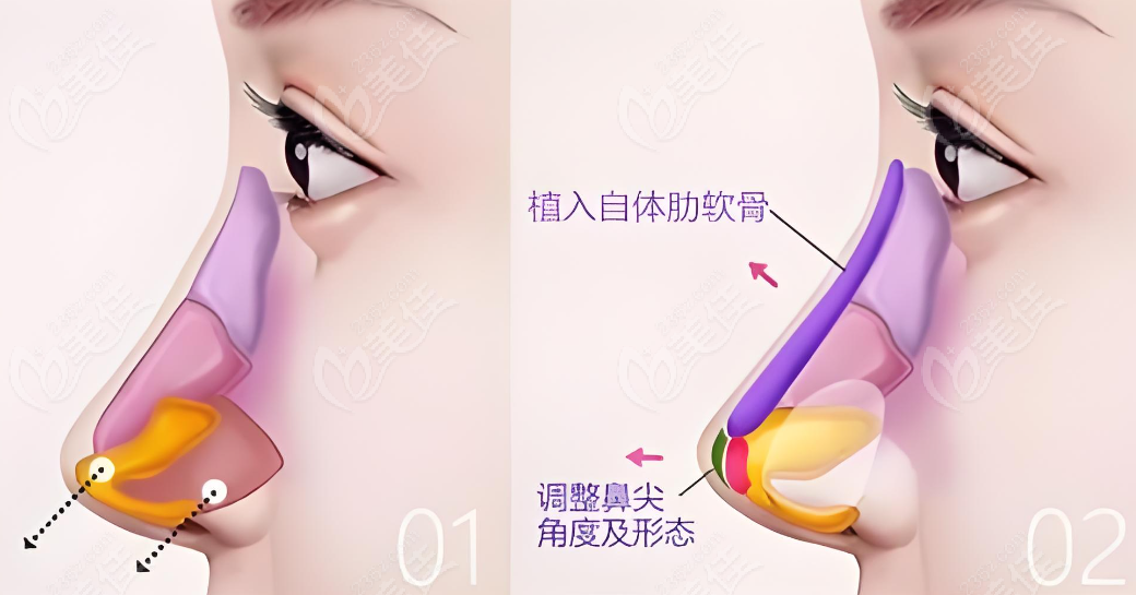 沈正宇隆胸鼻子手术技术好,属于高端档次