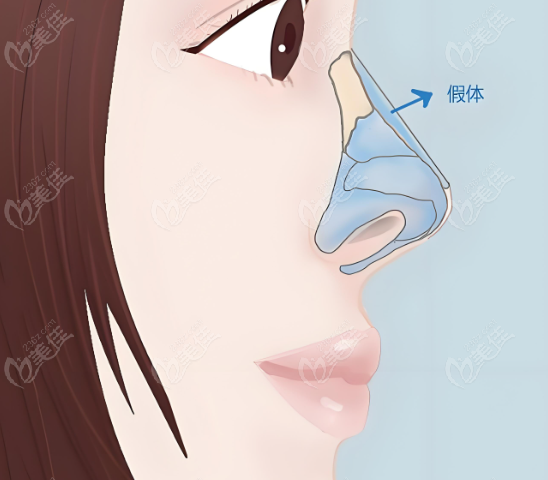 北京吴玉家鼻子做的好