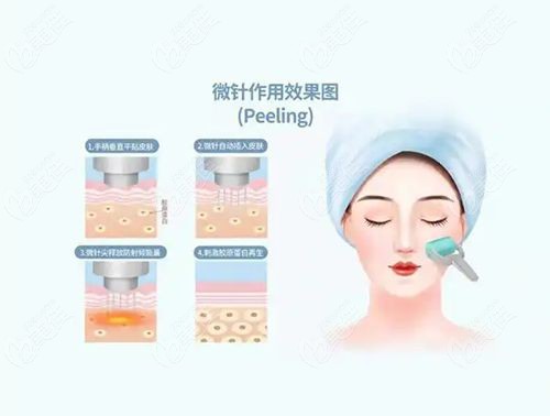 帝医思黄金微针和半岛黄金微针区别