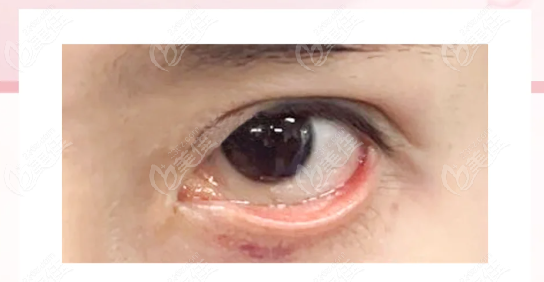 王*贺洁修复眼袋谁腻害