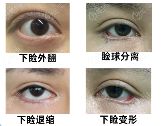 贺洁修复眼袋价格