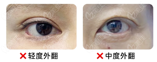 贺洁眼袋修复实例