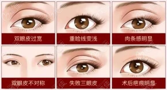 沈阳双眼皮修复多少钱价格价位表一览（沈城眼失败修复手术均价为：11800元）