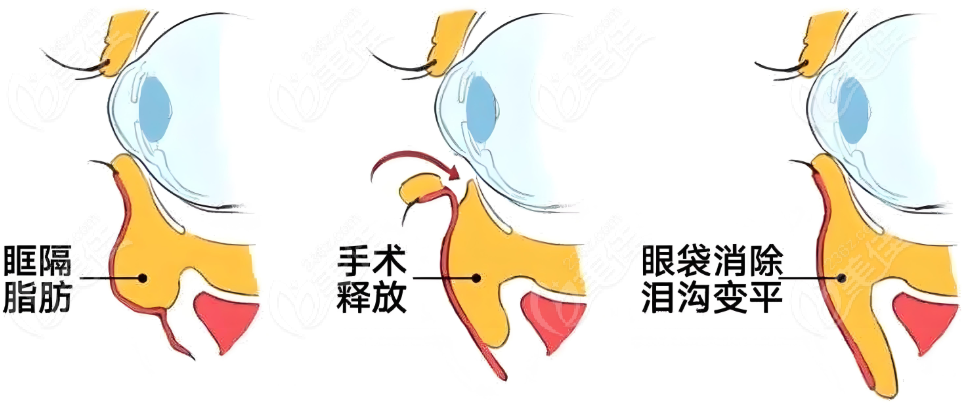 近一年祛眼袋手术市场价格统计 近一年祛眼袋手术市场价格统计