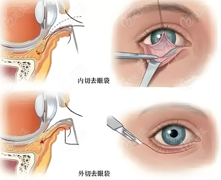 去眼袋手术