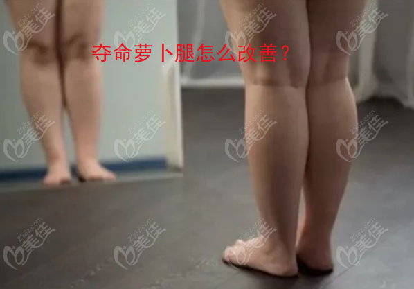 夺命萝卜腿怎么改善？从萝卜腿形成原因看可以通过吸脂/注射等整形方式快速改善！