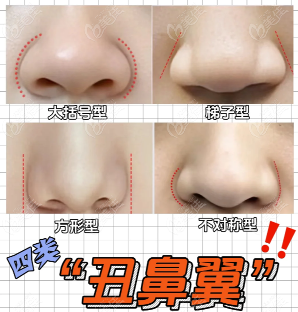 周柯鼻翼手術(shù)做的好