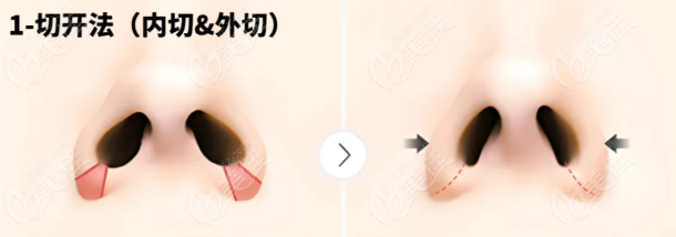 周柯鼻翼手術(shù)圖片