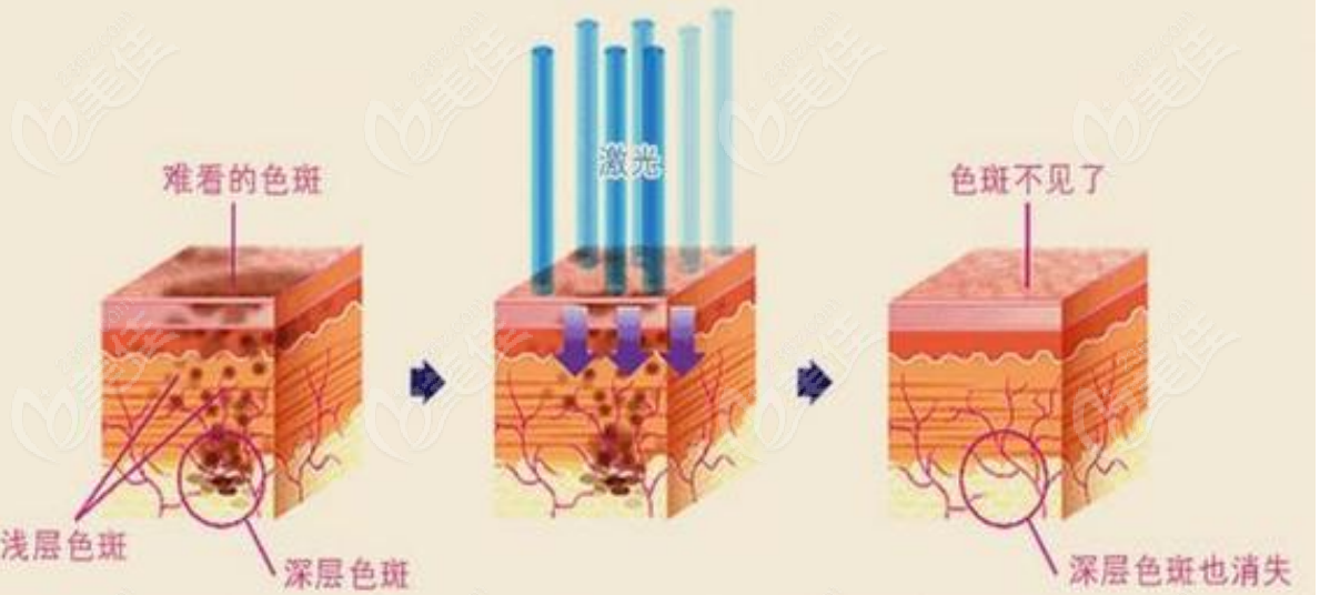 激光祛斑医院排名