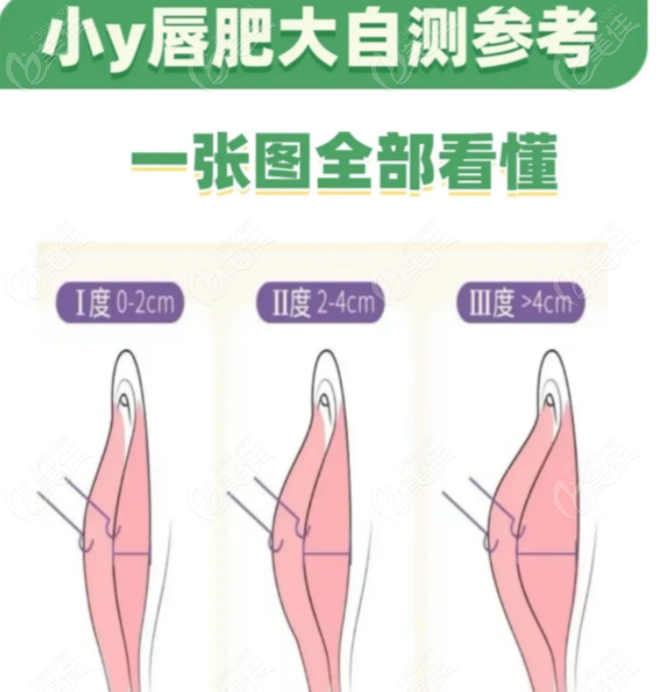 国内阴唇整形医院排名