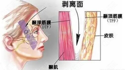 松垂脸面部提升为什么大家都建议筋膜提升？筋膜提升几年后会更老吗？