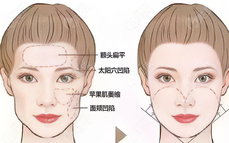 宋建星面部脂肪填充前后对比图片