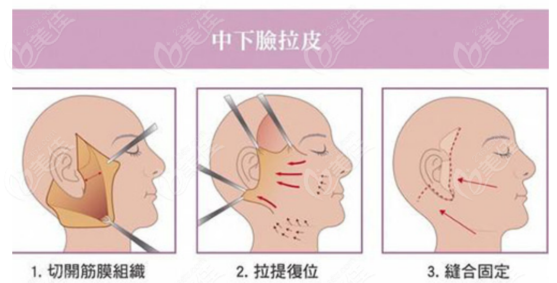 236z.com广州拉皮手术示意图