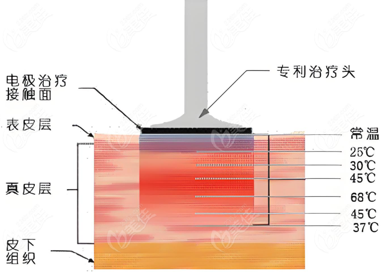 国内电波拉皮手术选择医院的综合考量