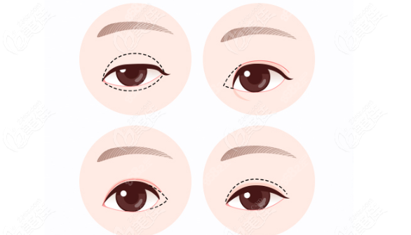 北京王阔远医生修复眼睛怎么样