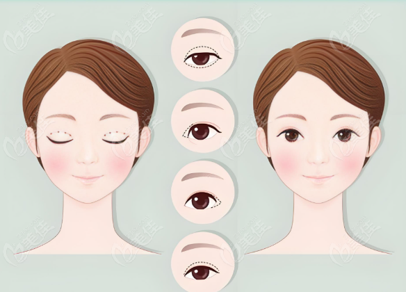 双眼皮整形手术