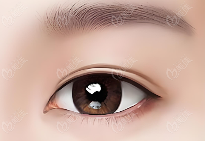 长沙张姣姣双眼皮修复做的怎么样？