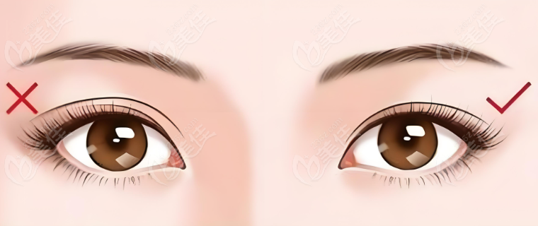 长沙张姣姣双眼皮修复价格收费