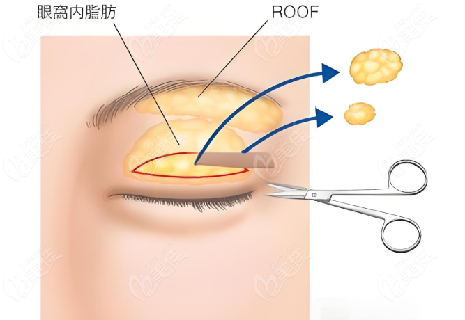 长沙张娇娇医生眼修复预约挂号