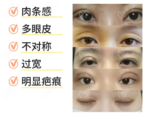 蔡灵修复双眼皮手术经验多