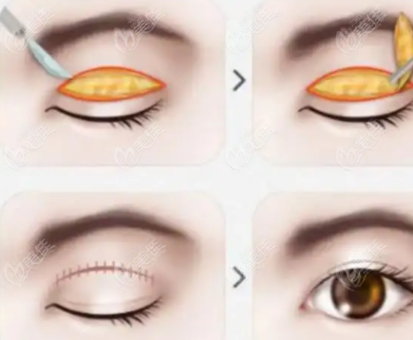 236z.com李光琴医生眼修复