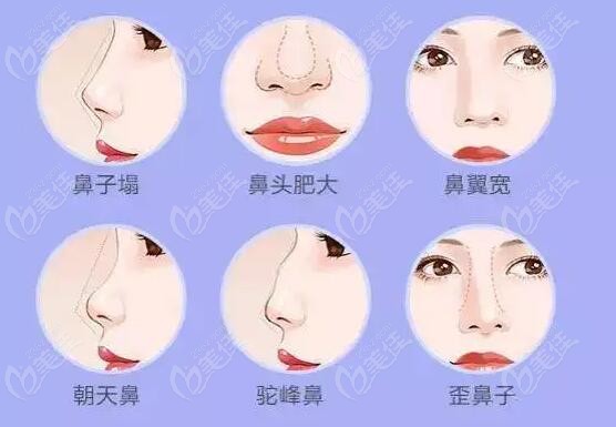沈阳妈生鼻哪位医生好？推荐朱石江、王滨福等10位大拿做幼态妈生鼻好果然名不虚传